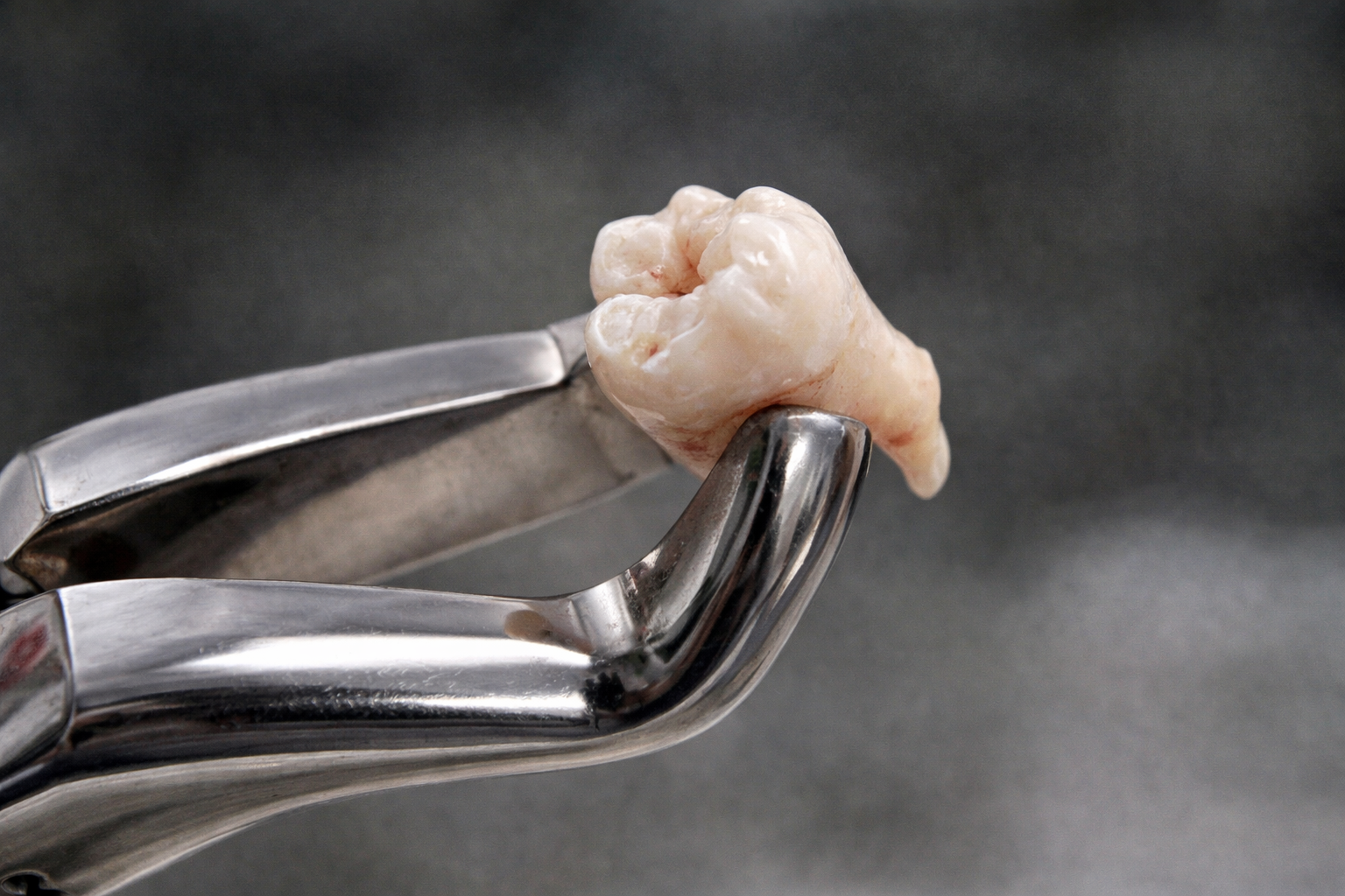 분당 치과 사랑니 발치 당일 지혈 및 안정